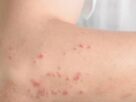 Dermatite atópica impacta rotina de milhões de brasileiros com inflamação crônica