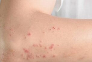 Dermatite atópica impacta rotina de milhões de brasileiros com inflamação crônica