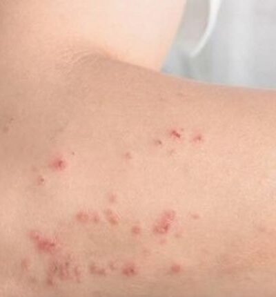 Dermatite atópica impacta rotina de milhões de brasileiros com inflamação crônica