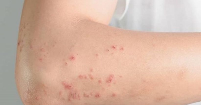 Dermatite atópica impacta rotina de milhões de brasileiros com inflamação crônica