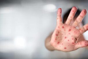 Entenda o que é a amnésia imunológica do sarampo que pode aumentar o risco de outras infecções