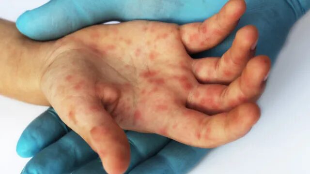 Estado de São Paulo confirma 23 casos de sarampo; 16 não se vacinaram
