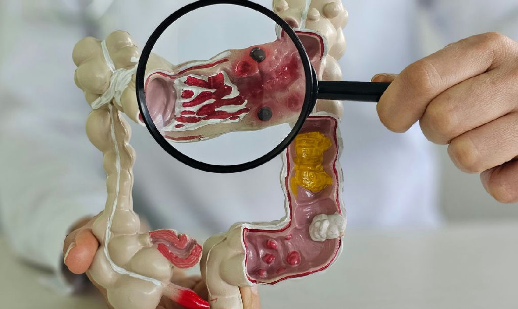 Doenças inflamatórias intestinais quintuplicam no Brasil em 13 anos
