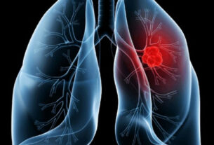 Entenda o adenocarcinoma pulmonar, diagnóstico que levou o papa Leão à cirurgia