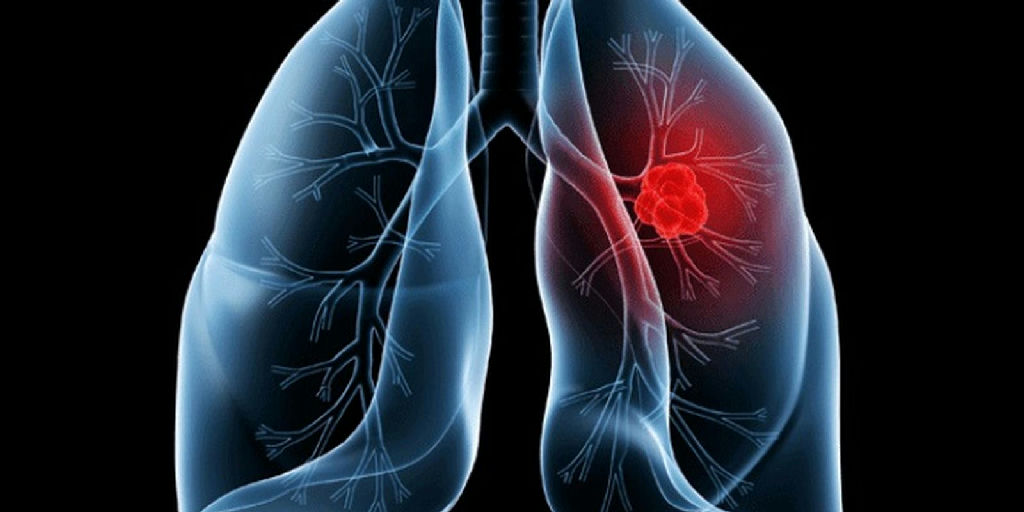 Entenda o adenocarcinoma pulmonar, diagnóstico que levou o papa Leão à cirurgia