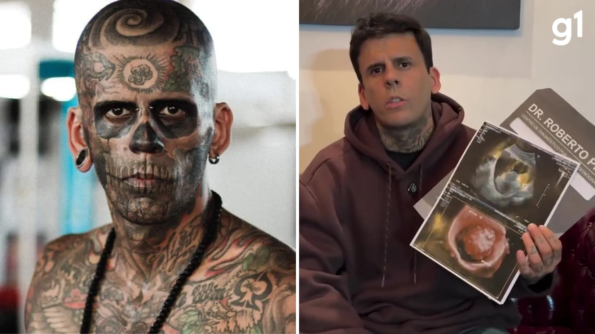 Leandro de Souza, o homem mais tatuado do Brasil, enfrenta câncer e busca cura via SUS